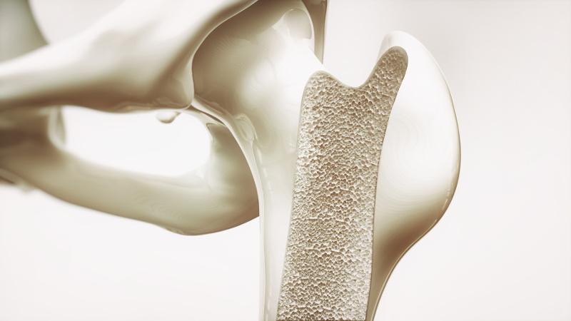 osteoporoza